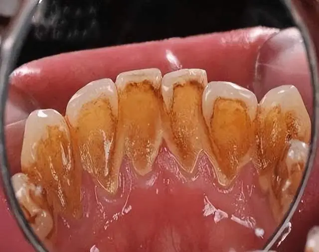珍珠亮白牙粉对人有什么害处_珍珠亮白牙粉效果怎样_效果珍珠亮白牙粉怎么使用